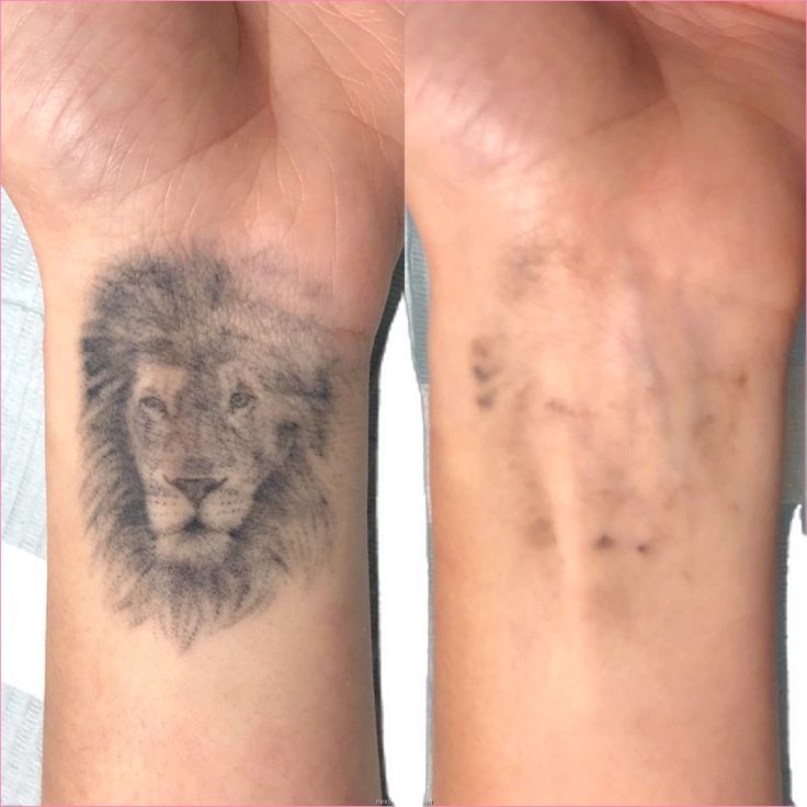 Tattoo Removal Process