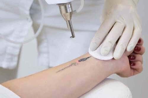 Tattoo removal Process