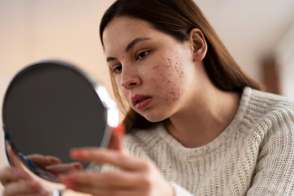 a girl is looking acne on her face in mirror