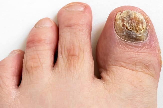 Nail Infection Treatments