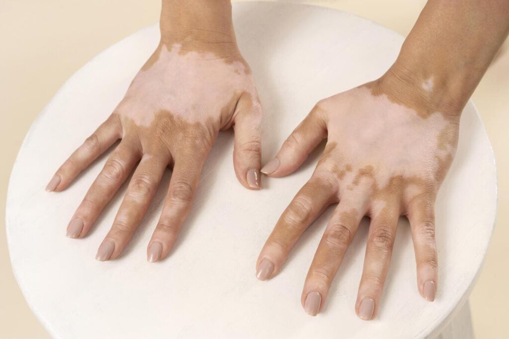 Vitiligo on hands